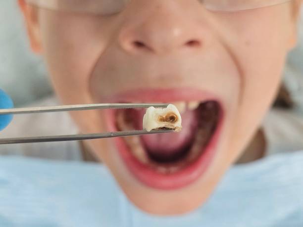 Best Broken or Chipped Tooth Repair in Miami Springs, FL