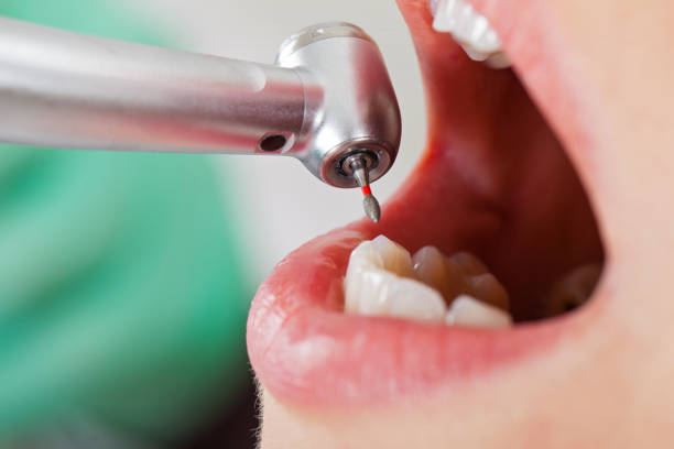 Best Emergency Wisdom Tooth Extraction in Miami Springs, FL
